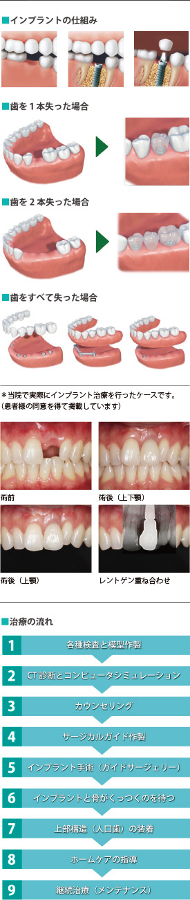 インプラントの仕組み